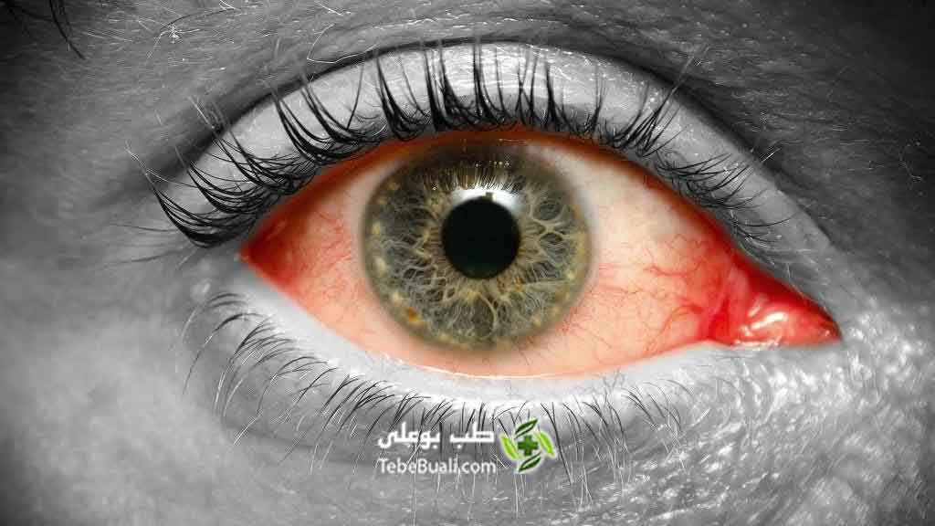 درمان قرمزی چشم‌ با طب سنتی