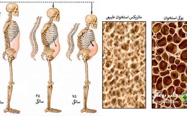 درمان پوکی استخوان با طب سنتی